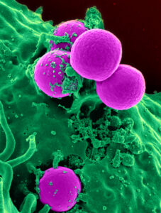 Scanning electron micrograph of a human neutrophil ingesting MRSA.