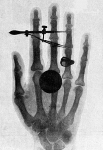 An X-ray of Wilhelm Roentgen's wife's hand.